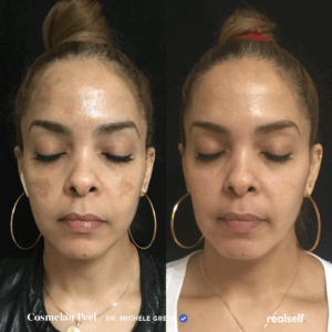 PARA AYUDA CON EL MELASMA